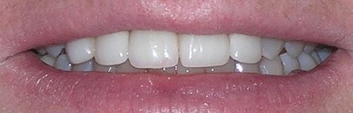 A close up of a person 's mouth with white teeth.