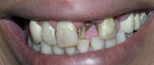 A close up of a person 's teeth with a broken tooth.