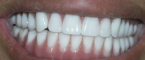 A close up of a person 's teeth with white teeth.