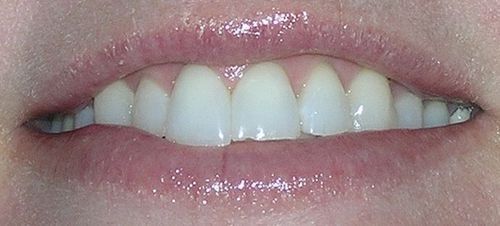 A close up of a woman 's mouth with white teeth.