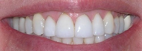 A close up of a person 's mouth with white teeth.