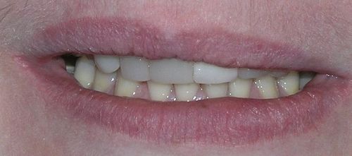 A close up of a person 's mouth with missing teeth.