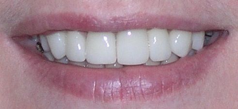 A close up of a person 's mouth with white teeth.