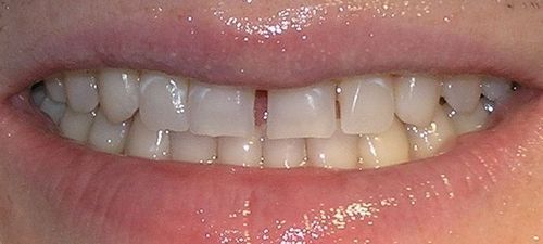 A close up of a person 's teeth with a missing tooth.