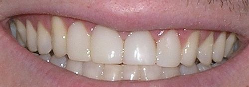 A close up of a man 's teeth with a smile on his face.