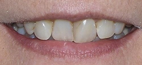 A close up of a person 's mouth with white teeth.