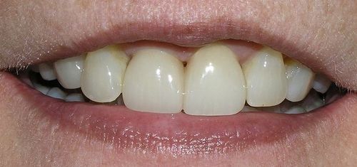 A close up of a person 's mouth with white teeth.