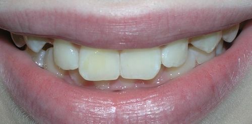 A close up of a person 's mouth with white teeth.