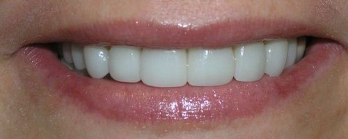 A close up of a woman 's mouth with white teeth.