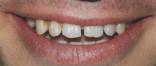 A close up of a man 's mouth with missing teeth.