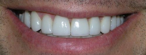 A close up of a man 's smile with white teeth.