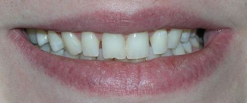 A close up of a person 's mouth with white teeth.