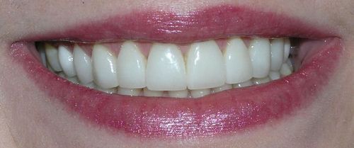 A close up of a woman 's smile with white teeth and red lips.