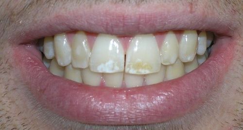 A close up of a man 's mouth with white teeth.