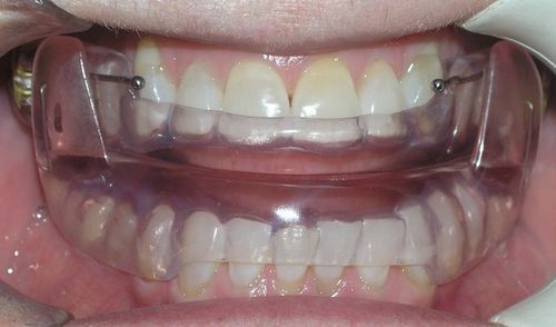 A close up of a person 's mouth with braces on their teeth.