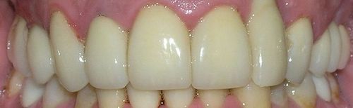 A close up of a person 's teeth with white teeth.