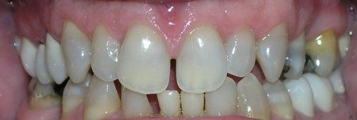 A close up of a person 's teeth with a broken tooth.