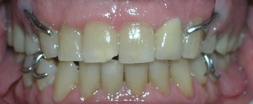 A close up of a person 's teeth with metal braces.