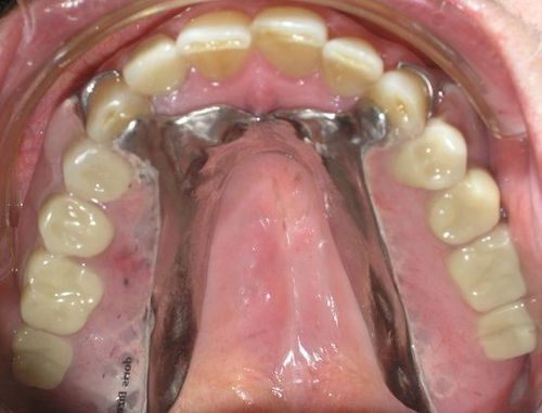 A close up of a person 's mouth with a metal brace on their teeth.