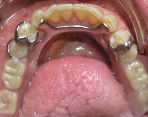 A close up of a person 's mouth with metal braces on their teeth