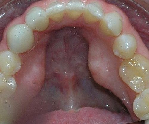 A close up of a person 's mouth with a lot of teeth.