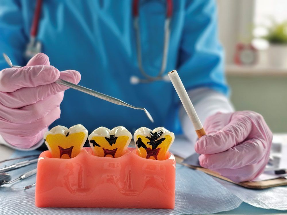 Dental model showing tooth decay effects compared with smoking risk