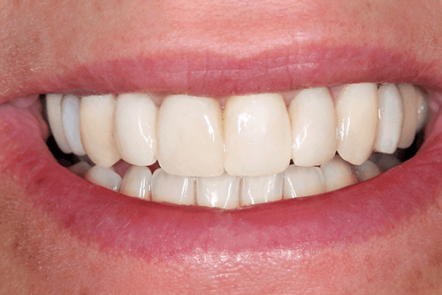 smile after veneers and crowns