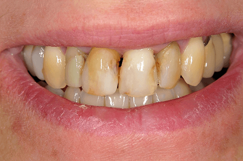 smile before veneers and crowns