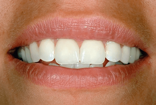 smile after porcelain veneers