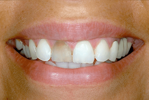 smile before porcelain veneers