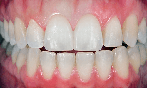 teeth after veneer application