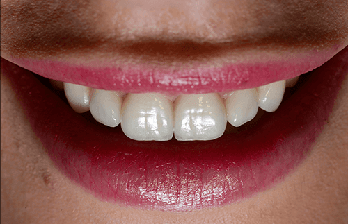 teeth after whitening and veneers