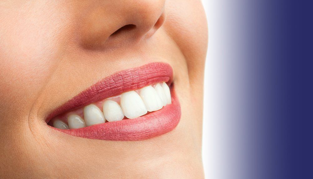 Teeth Whitening Dr. Rosado & Associates Miami, Fl 33165