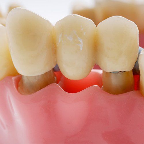 coronas y puentes dentales