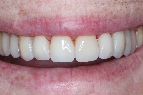 after front crowns