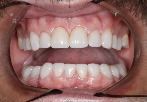 after full upper and lower veneers