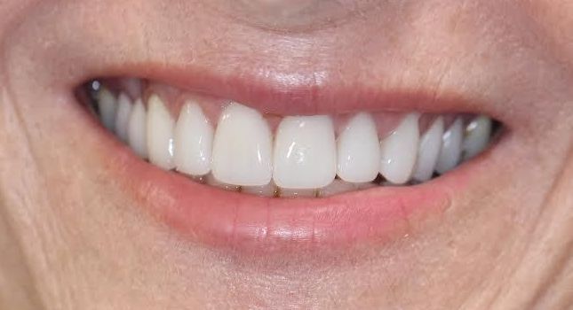 after smile makeover