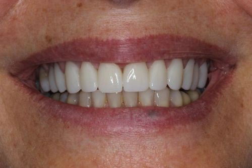 after veneers