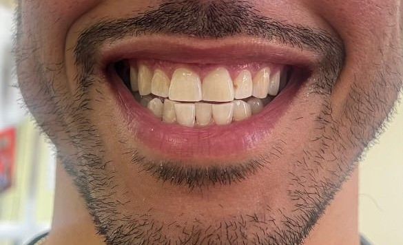 after teeth bleaching