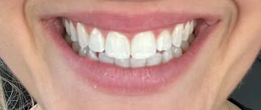 after teeth bleaching