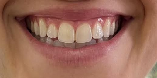 before teeth bleaching
