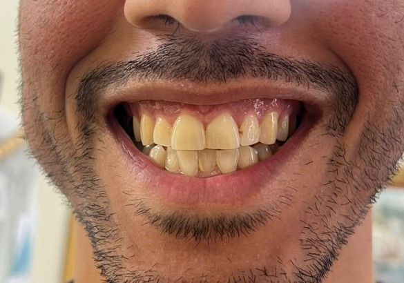 before teeth bleaching