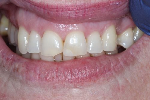 before front crowns