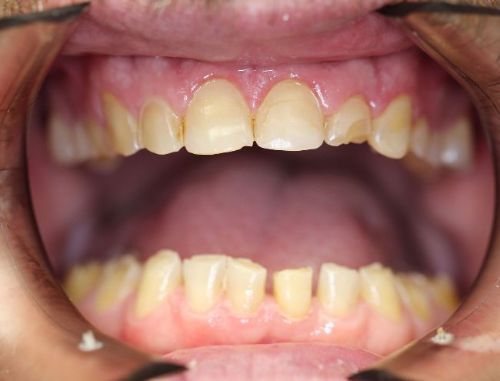 before full upper and lower veneers
