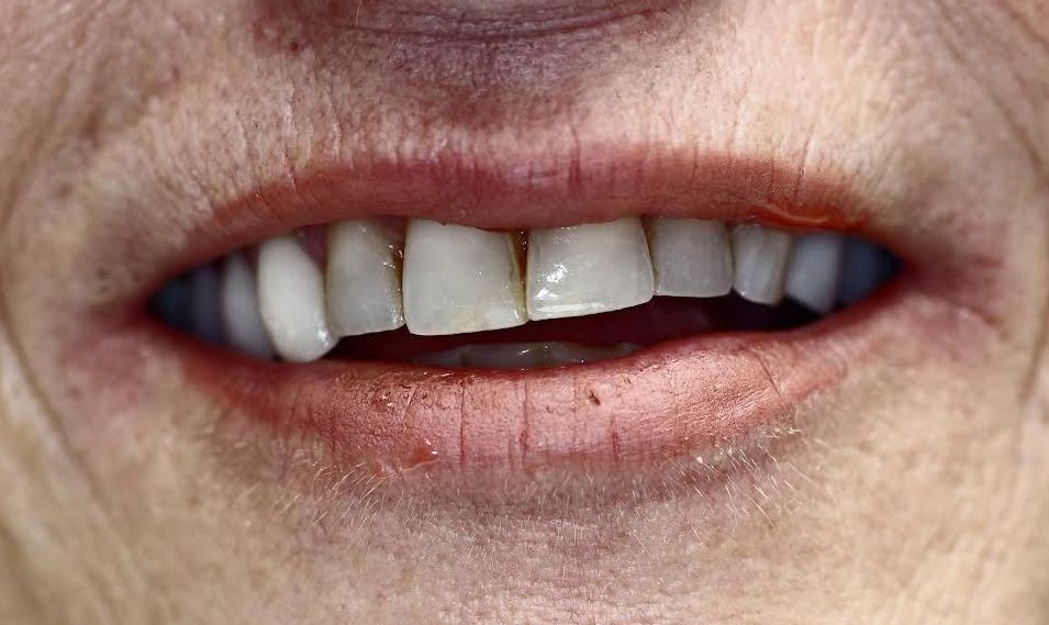 before smile makeover