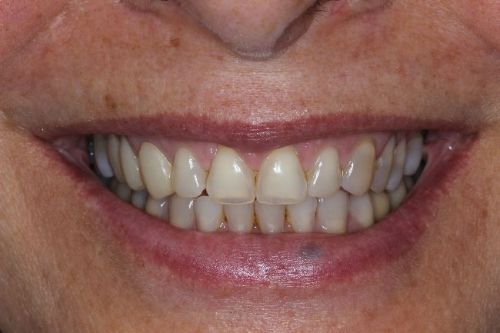 before veneers