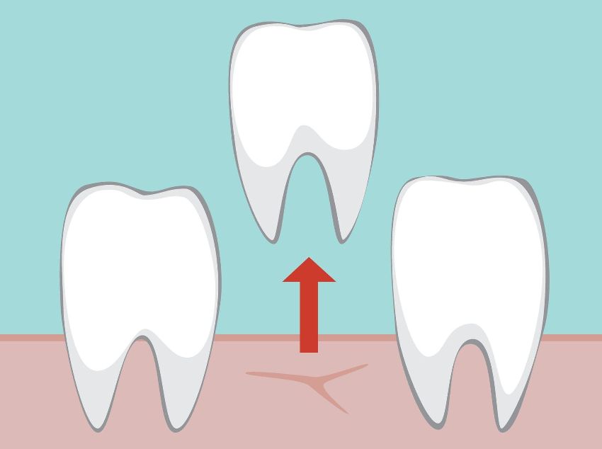 Tooth Extractions