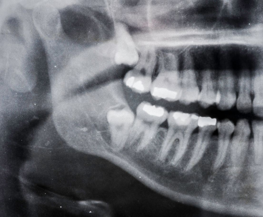 It is a black and white x-ray of a person 's teeth.