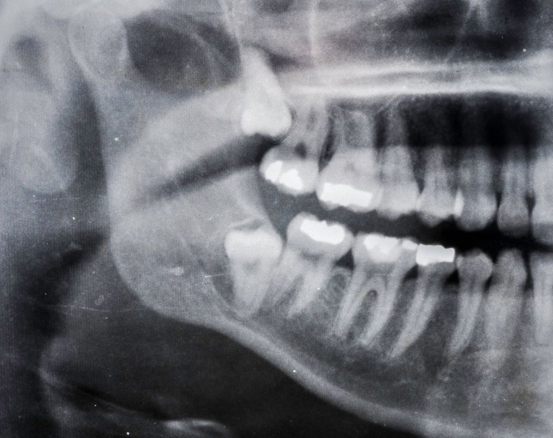 Una radiografía en blanco y negro de los dientes de una persona.