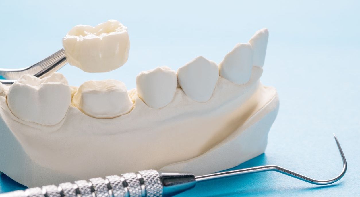 A model of a person 's teeth with a dental crown on it.